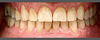 Invisalign image