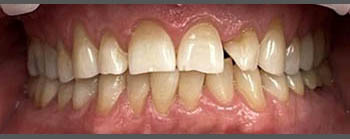 Invisalign image