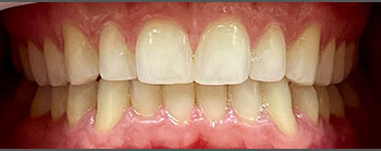 Invisalign image