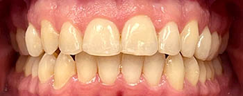 Invisalign image