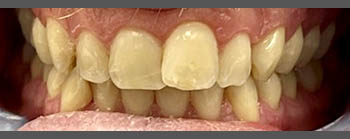 Invisalign image