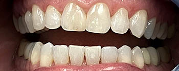 Invisalign image