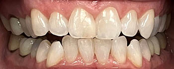 Invisalign image